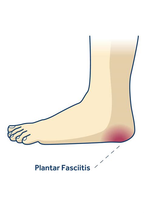 Plantar Fasciitis 的图像结果
