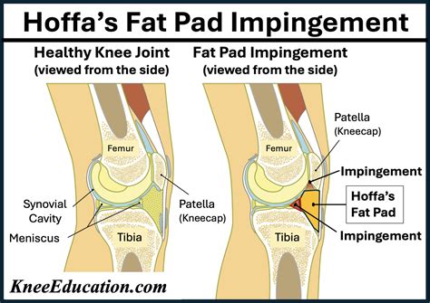 Inferomedial Vs Inferolateral
