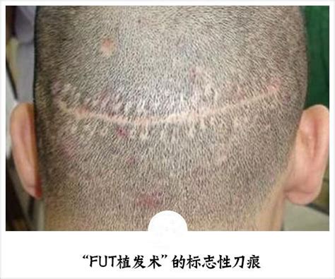 【盘点】FUT有痕头发种植和FUE微创植发技术哪里截然不同？_千颜网