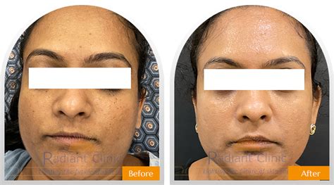 Before-After | Skin and Hair Treatment Results - Radiant Clinic