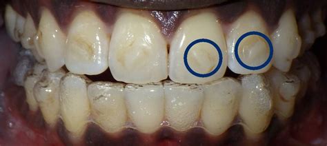 What Are Invisalign Attachments (Buttons): A Complete Guide | Invisalign attachments, Invisalign ...
