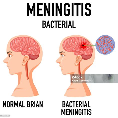 Diagram Showing Meningitis Bacterial In Brain Stock Illustration ...