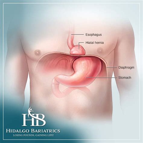 7 Essential Benefits of Hiatal Hernia Repair in Bariatric Surgery: What Bariatric Patients Need ...