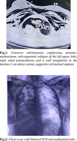 “The Leaky Airway”: Spontaneous Tracheo Bronchial Tree Injury