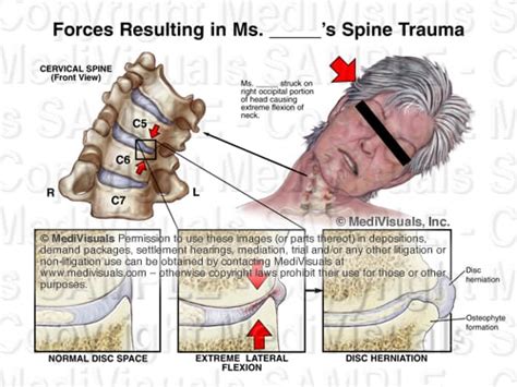 Understanding the Osteophyte/Disc Complex in Spinal Trauma