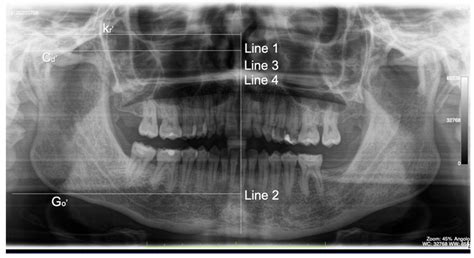 Mandibular Coronoid Process Hypertrophy: Diagnosis and 20-Year Follow ...