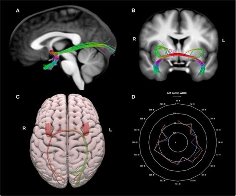 Anterior Commissure Mri