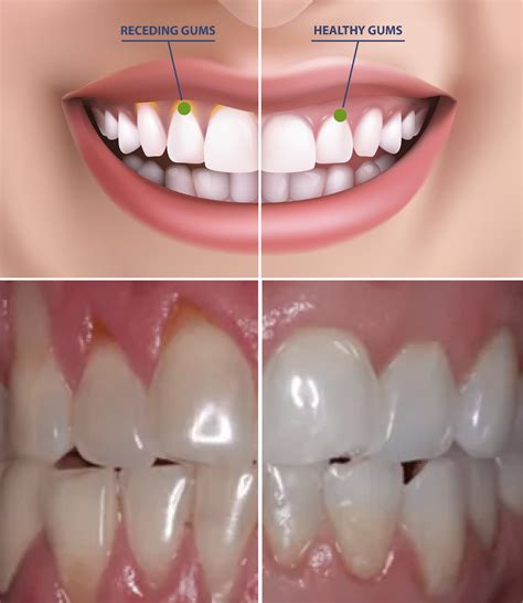 Healthy Gums Vs Unhealthy Gums