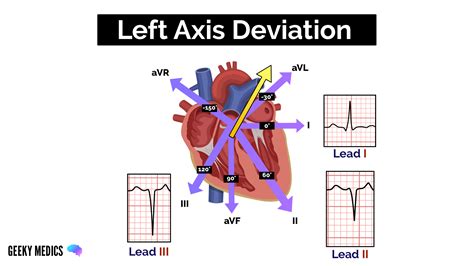 Abnormal Ecg Interpretation