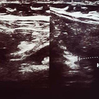 Image result for Undulation Defect