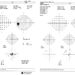 Image result for Paracentral Visual Field Defect