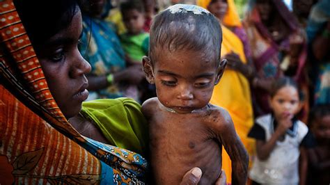 India Made no Progress in Reducing Anaemia and Childhood Wasting, Says ...
