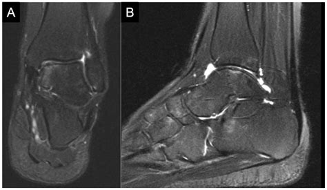 Juvenile Osteochondral Lesions of the Talus: Current Concepts Review ...
