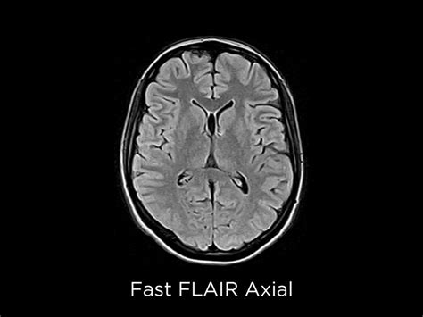 Whoole Body MRI advanced imaging tools: Clinical Applications - Esaote