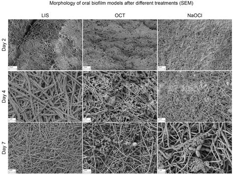 Effect of Mouth Rinsing and Antiseptic Solutions on Periodontitis ...