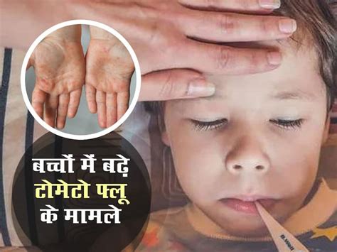 केरल और तेलंगाना में बढ़े टोमेटो फ्लू के मामले, 5 साल के दो बच्चों में ...
