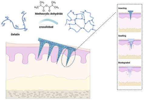 Hydrogel-Forming Microneedles with Applications in Oral Diseases Management