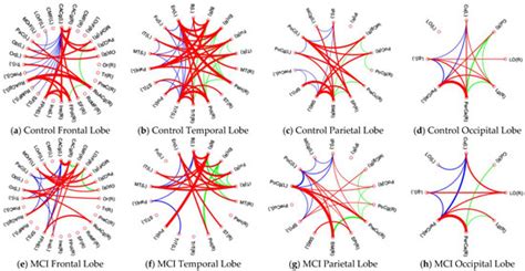 Decreased Brain Structural Network Connectivity in Patients with Mild ...