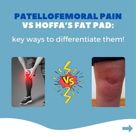 Patellofemoral Pain Vs Hoffa’s Fat Pad — Physio Network