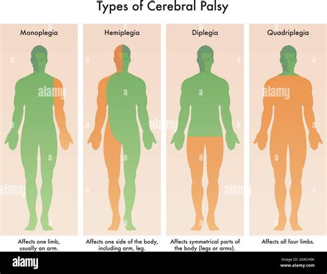 Arm Hemiplegia Definition at Eva Timmins blog