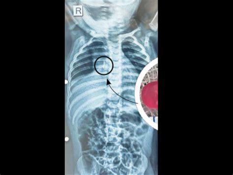 A one and a half year old child was brought to Gotri Hospital with cold ...