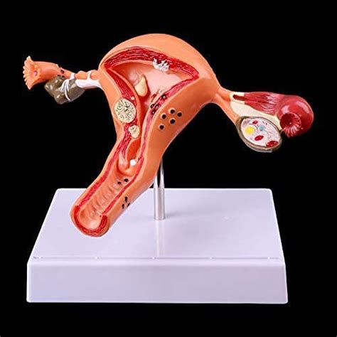 Buy Anatomy Model, Assembly Pathological Uterus Ovary Anatomical Model ...