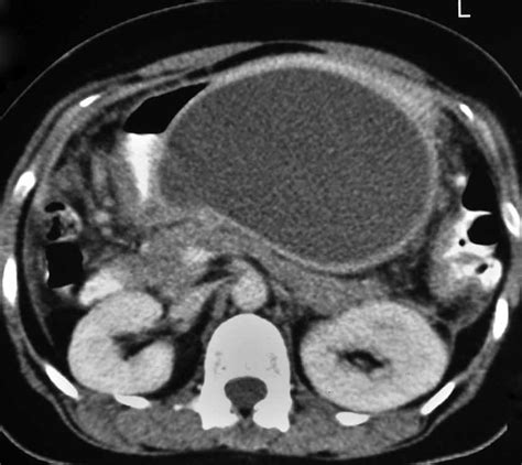 Impending Rupture of Lesser Sac Biloma into the Stomach