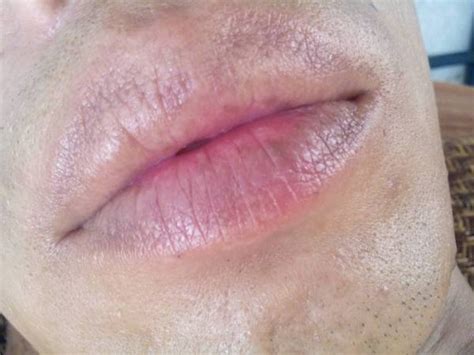 【图】嘴唇上有黑斑是什么原因？ 几个妙招教你如何预防黑斑(2)_嘴唇上有黑斑_伊秀美容网|yxlady.com