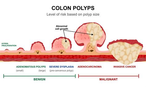 Bowel Polyps Photos