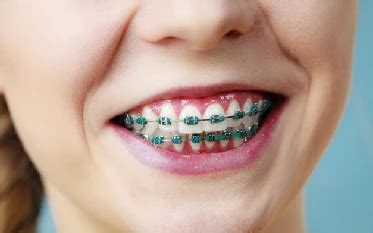 Image result for braces