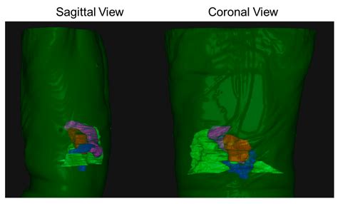 Inter-Breath-Hold Geometric and Dosimetric Variations in Organs at Risk ...