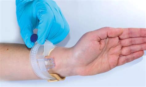 Distal radial artery lowers risk of hematomas, occlusion: JACC