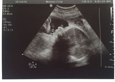 37 Week Ultrasound 2d