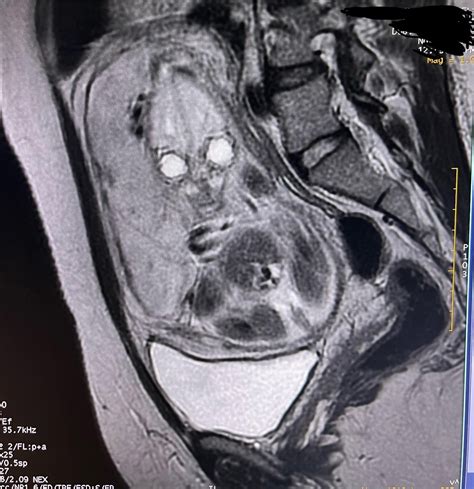 A photo of an MRI scan of a 26wks pregnant patient front and side angle ...