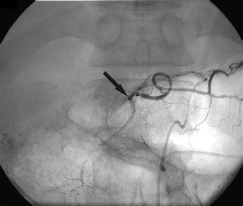 Efficacy of the Left Gastric Artery as a Route for Catheterization of ...