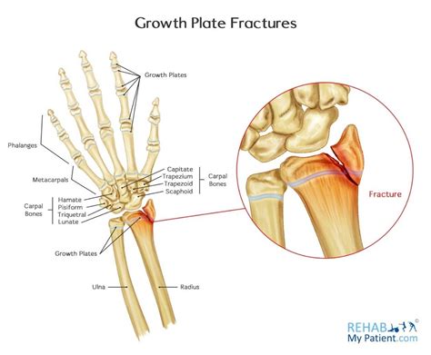 Growth Plate Fractures | Rehab My Patient
