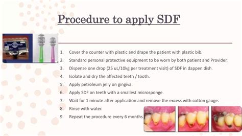 SILVER DIAMINE FLUORIDE (SDF) | PPTX