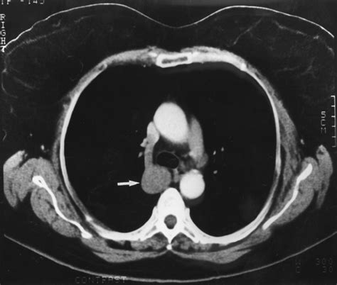 Azygos Vein Ct Corona