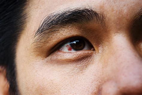 Red Spot on Eye: What It Could Mean | Reader's Digest