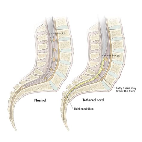 Tethered Spinal Cord Syndrome Dynamic Magnetic Resonance Imaging