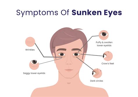 5 quickest ways to get rid of sunken eyes – Re'equil