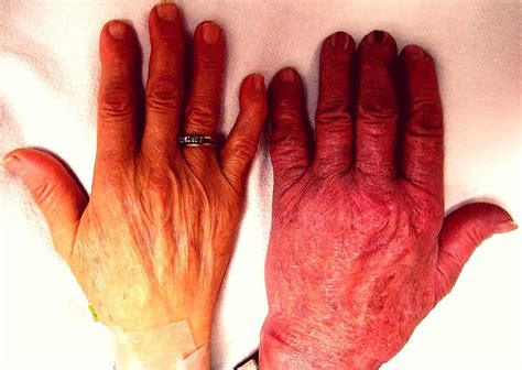 Fanconi Anemia: फैंकोनी एनीमिया क्या है? जानें इसके लक्षण और उपाय ...