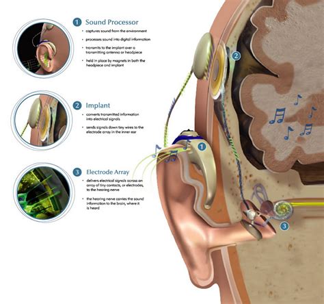 Image result for Cochlear
