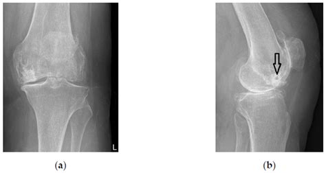 Tissue Integration of Calcium Phosphate Compound after Subchondroplasty ...