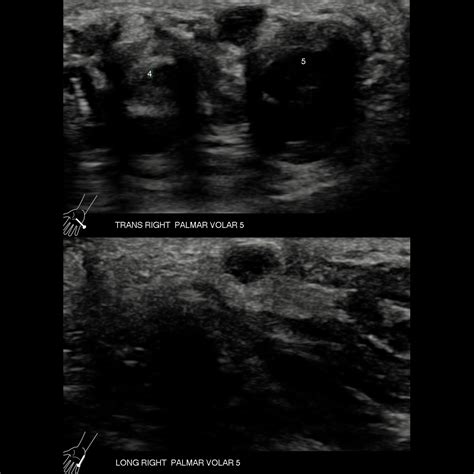 Pediatric Ganglion Cyst / Synovial Cyst | Pediatric Radiology Reference Article | Pediatric ...