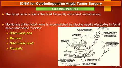 IONM for Cerebellopontine Angle Tumor Surgery | PPTX