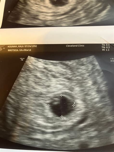 Identical Twins Ultrasound 5 Weeks