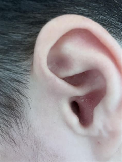 Ear Eczema Treatment Nz at James Velarde blog