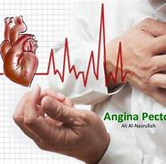 angina pectoris 的图像结果