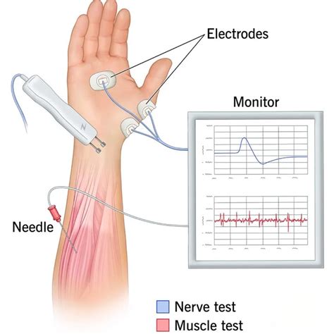 Image result for EMG Back Test
